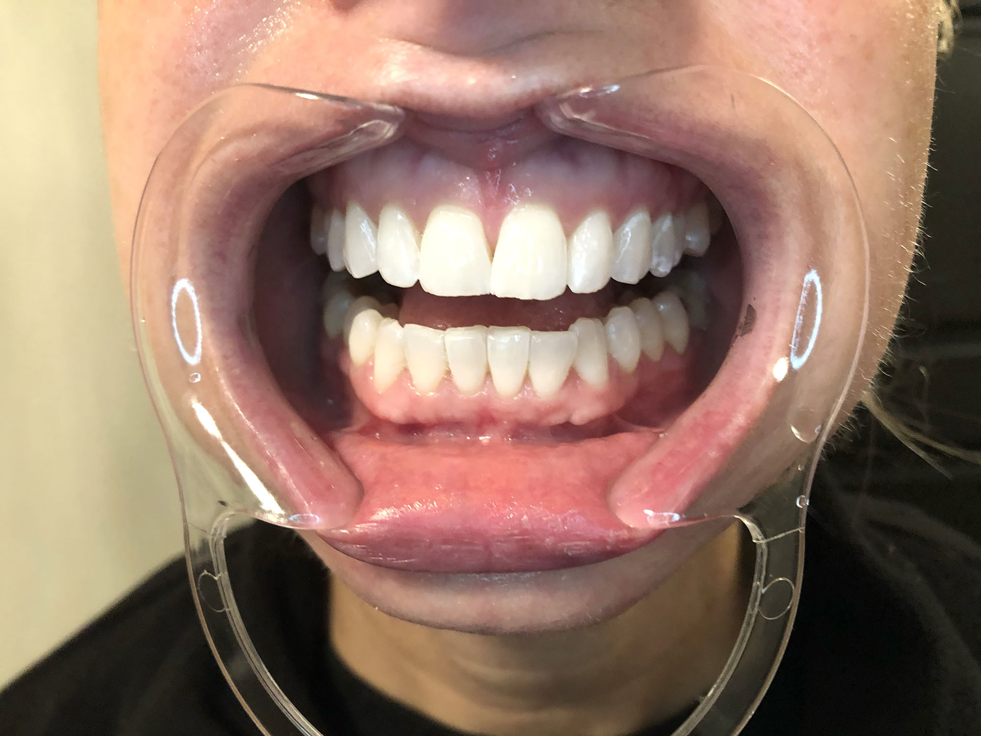 teeth-after